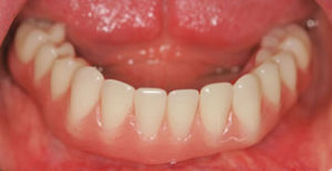 Hybrid Dentures | Mid-Cities OMS | Colleyville, TX