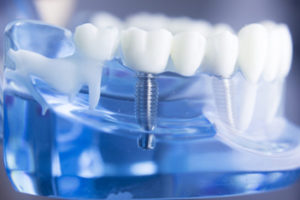 dental implants Mid-Cities OMS | Colleyville, TX