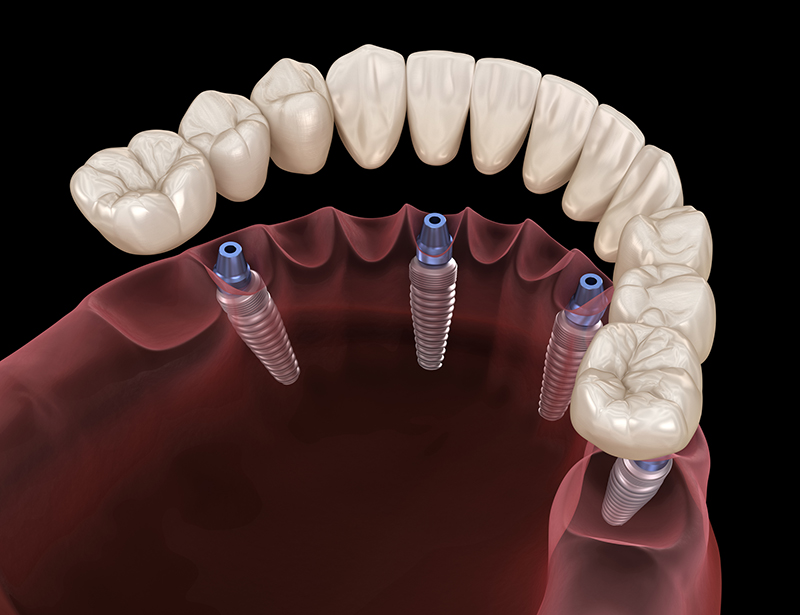 All on 4 implants | Mid-Cities OMS | Colleyville, TX
