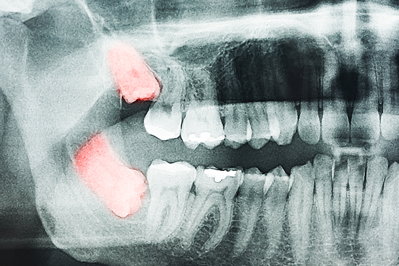 xray of wisdom teeth | Mid-Cities OMS | Colleyville, TX